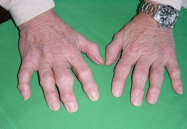 L'arthrose des doigts