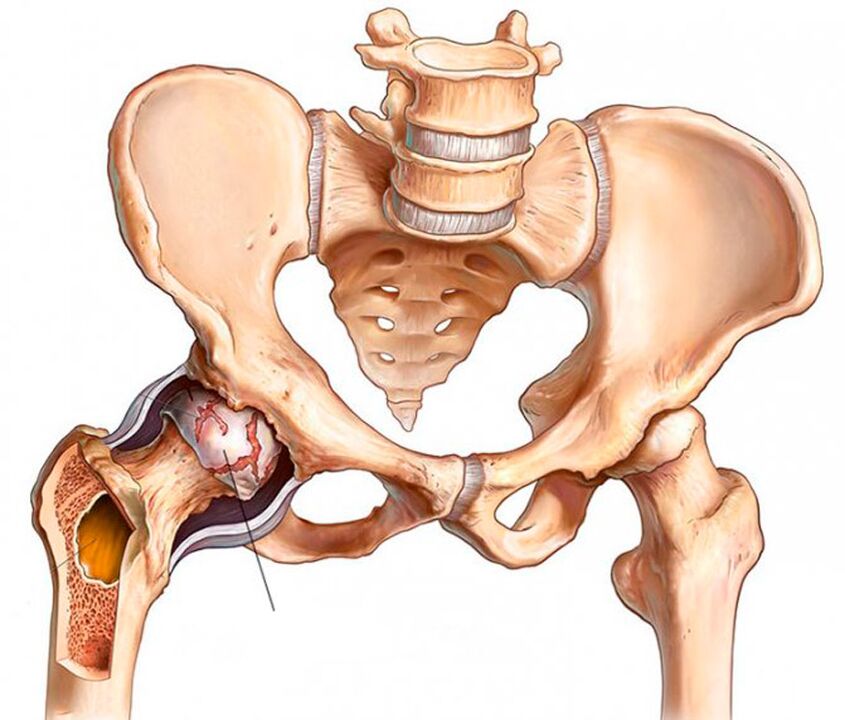 Arthrose de l'articulation de la hanche
