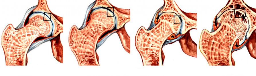 Le degré de développement de la coxarthrose de l'articulation de la hanche