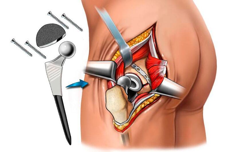 Pose d'une endoprothèse - une solution chirurgicale au problème de la coxarthrose