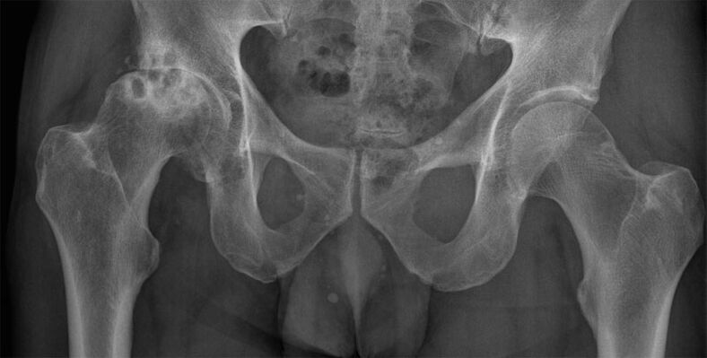 Radiographie de l'arthrose déformante de l'articulation de la hanche
