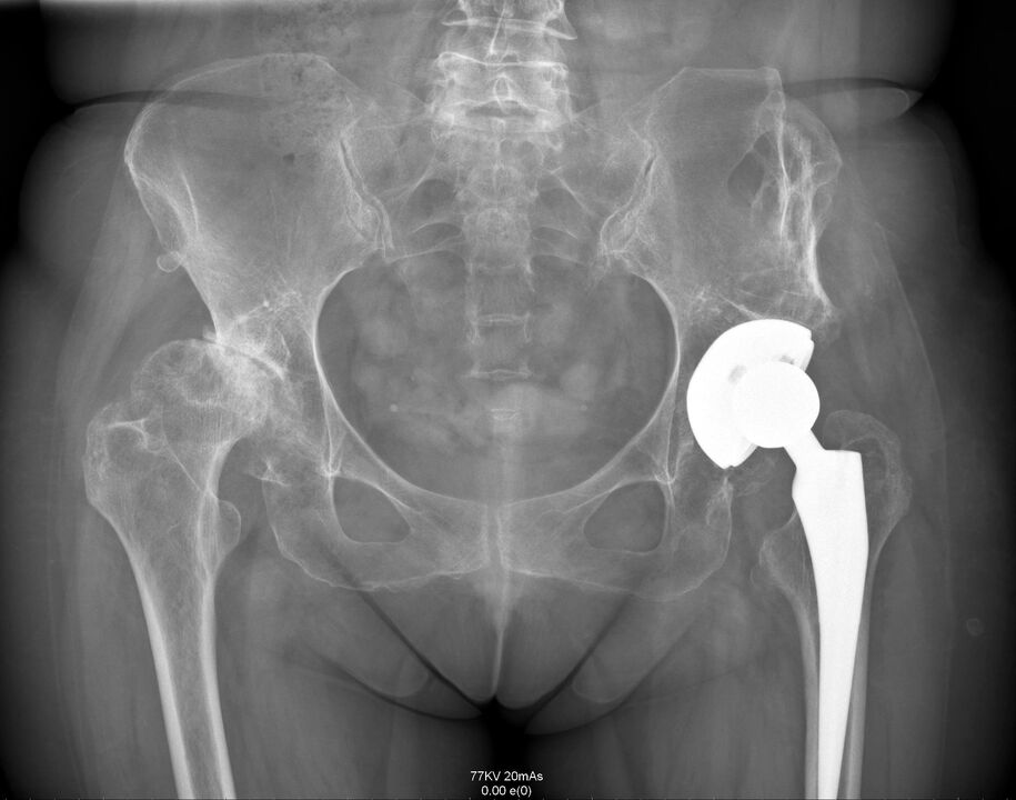 Radiographie de l'articulation de la hanche après endoprothèse