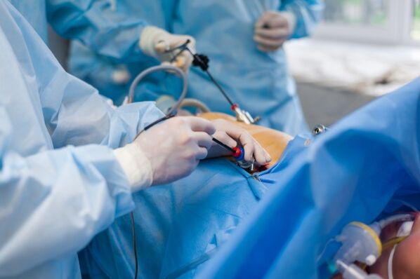 Au stade avancé de l'ostéochondrose du rachis lombaire, une intervention chirurgicale est nécessaire