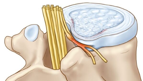 L'ostéochondrose lombaire peut entraîner des complications sous la forme d'une hernie intervertébrale