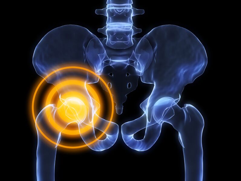Arthrose de la hanche