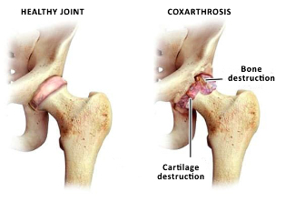 comparaison d'une bonne articulation de la hanche et sustave